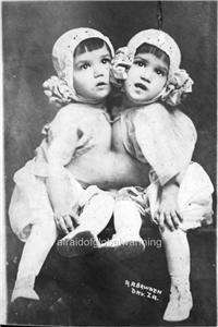 Photo 1910s Circus Freak Sideshow Cuban Siamese Twins  