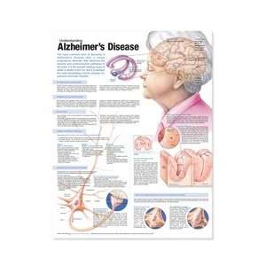 Understanding Alzheimers Disease Anatomical Chart, Second Edition 