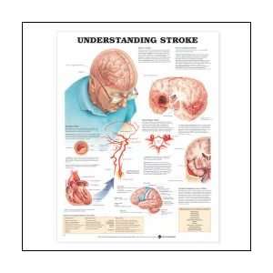  Understanding Stroke Anatomical Chart 20 X 26 Health 